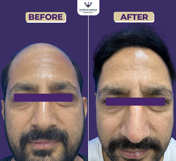 Plastic Surgery Patient of Dr. Lamoria