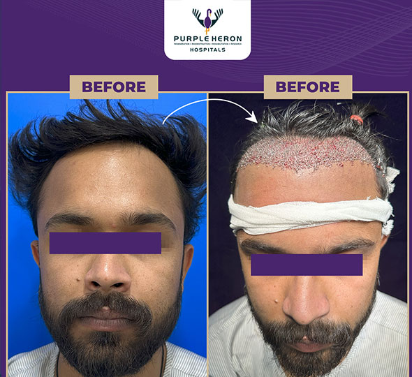 Plastic Surgery Patient of Dr. Lamoria