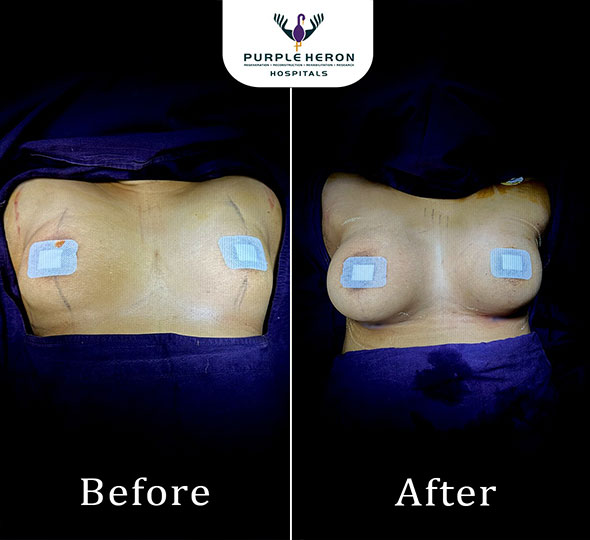 Plastic Surgery Patient of Dr. Lamoria