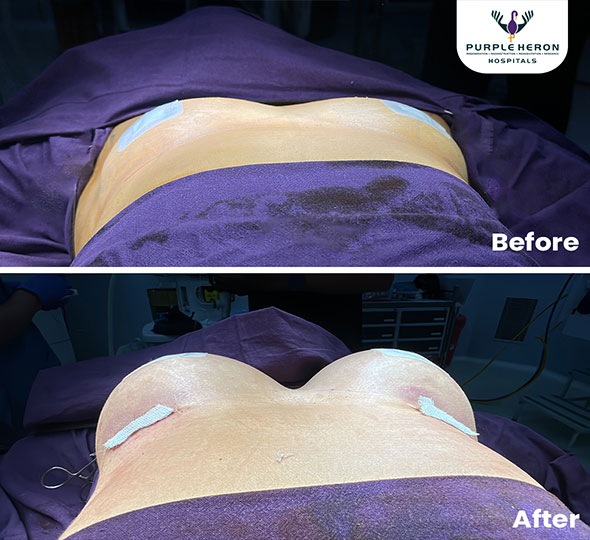 Plastic Surgery Patient of Dr. Lamoria