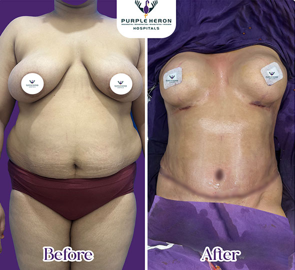 Plastic Surgery Patient of Dr. Lamoria