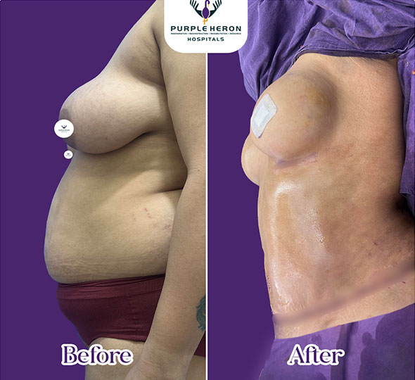 Plastic Surgery Patient of Dr. Lamoria