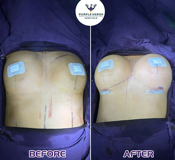 Plastic Surgery Patient of Dr. Lamoria