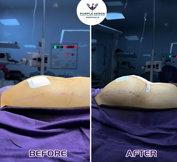 Plastic Surgery Patient of Dr. Lamoria