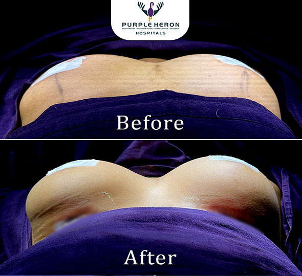 Plastic Surgery Patient of Dr. Lamoria