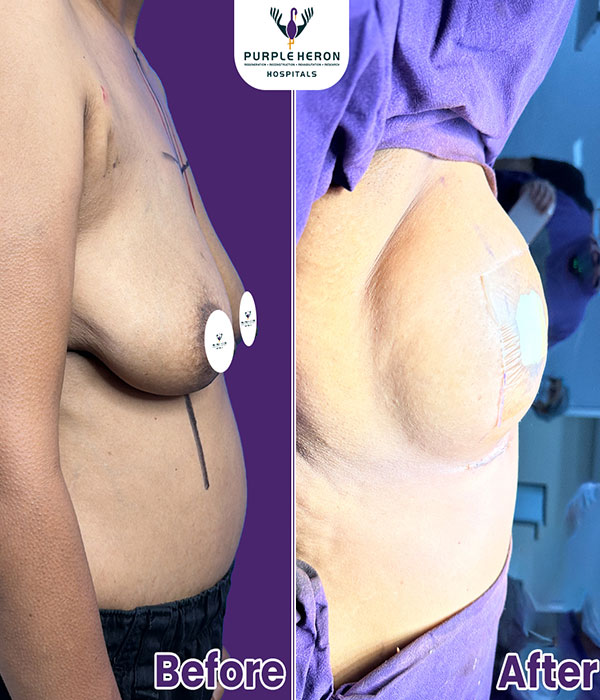 BREAST SURGERY