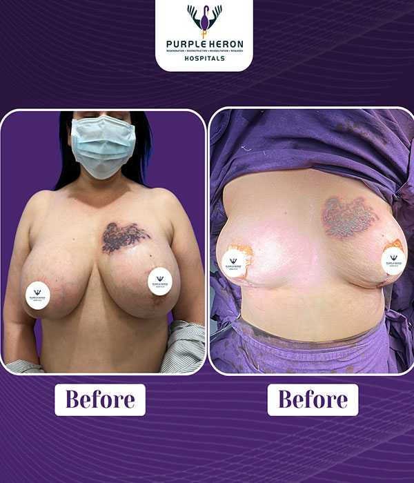 BREAST SURGERY