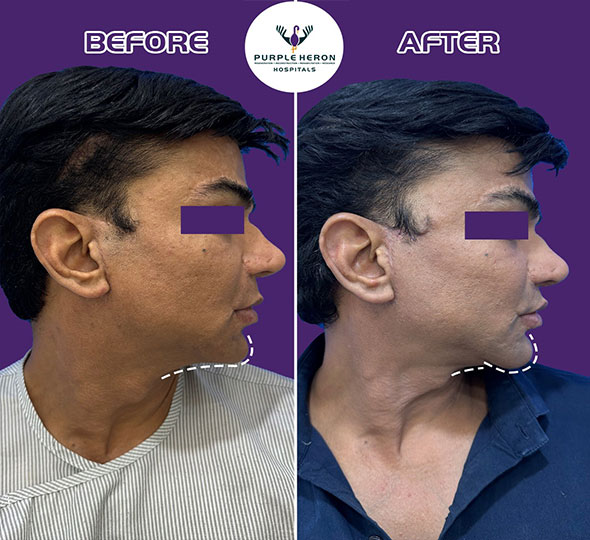 Plastic Surgery Patient of Dr. Lamoria