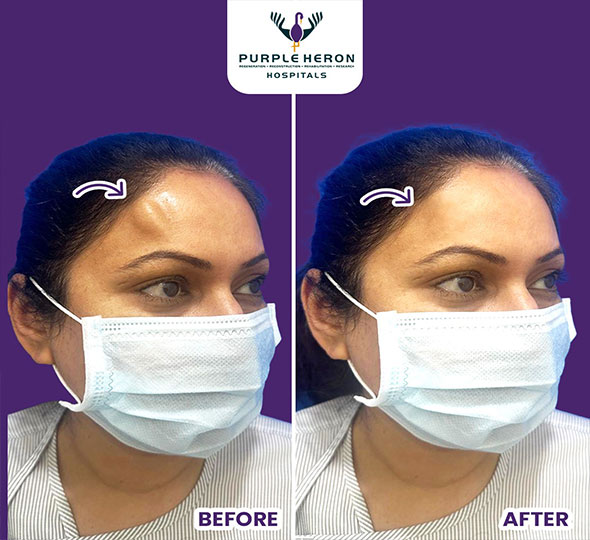 Plastic Surgery Patient of Dr. Lamoria