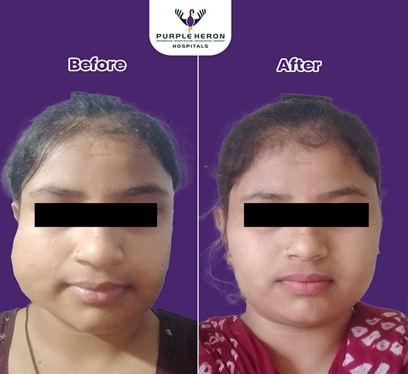 Plastic Surgery Patient of Dr. Lamoria