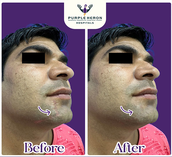 Plastic Surgery Patient of Dr. Lamoria