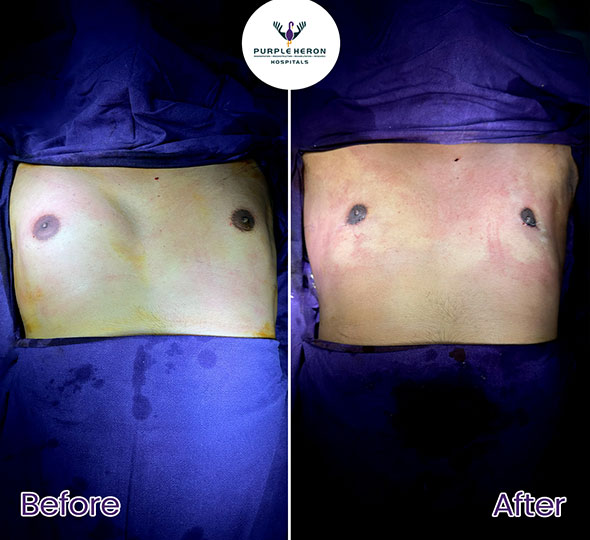 Plastic Surgery Patient of Dr. Lamoria