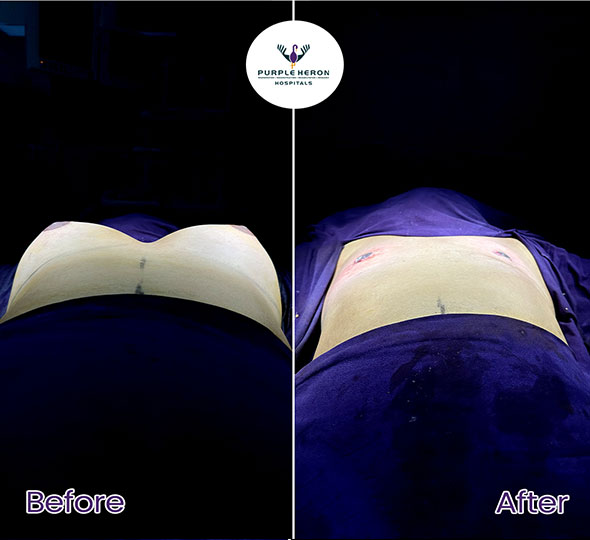 Plastic Surgery Patient of Dr. Lamoria