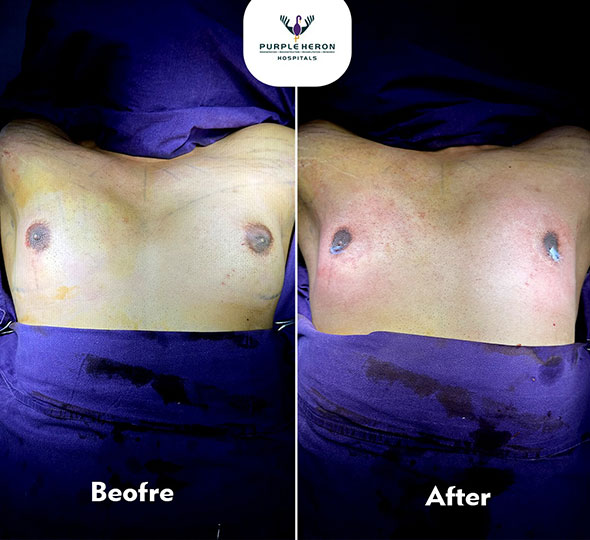 Plastic Surgery Patient of Dr. Lamoria