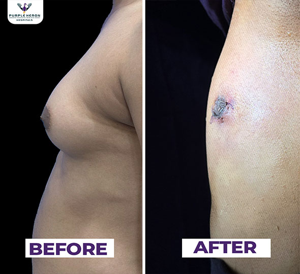 Plastic Surgery Patient of Dr. Lamoria