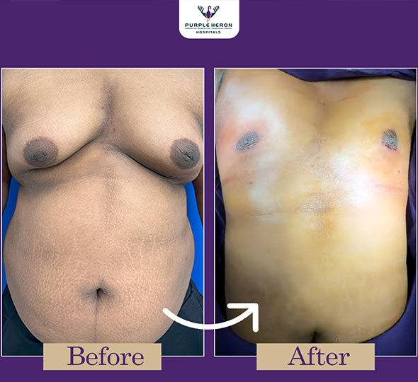 Plastic Surgery Patient of Dr. Lamoria