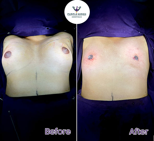 Plastic Surgery Patient of Dr. Lamoria