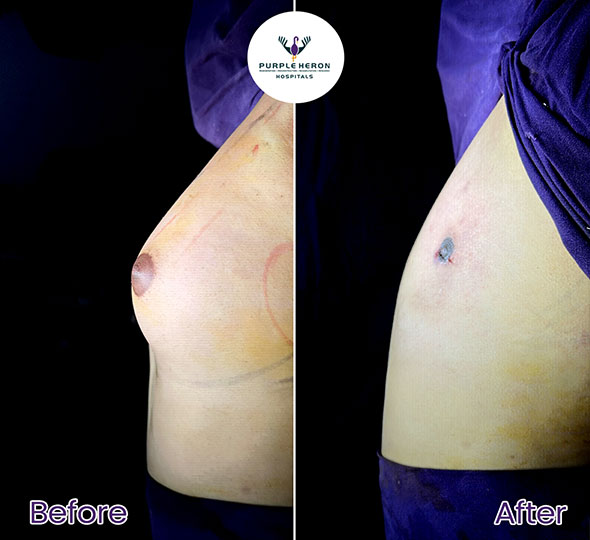 Plastic Surgery Patient of Dr. Lamoria