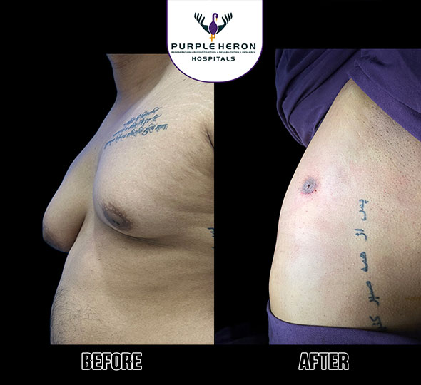 Plastic Surgery Patient of Dr. Lamoria