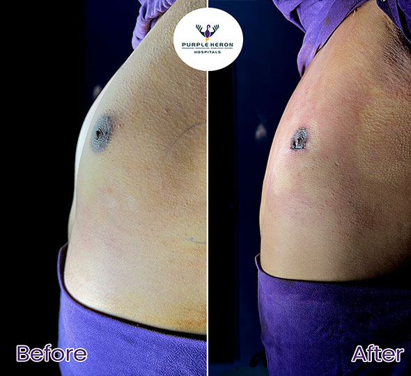 Plastic Surgery Patient of Dr. Lamoria