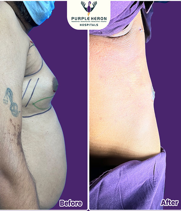 Dr. Nitesh Lamoria Gynecomastia