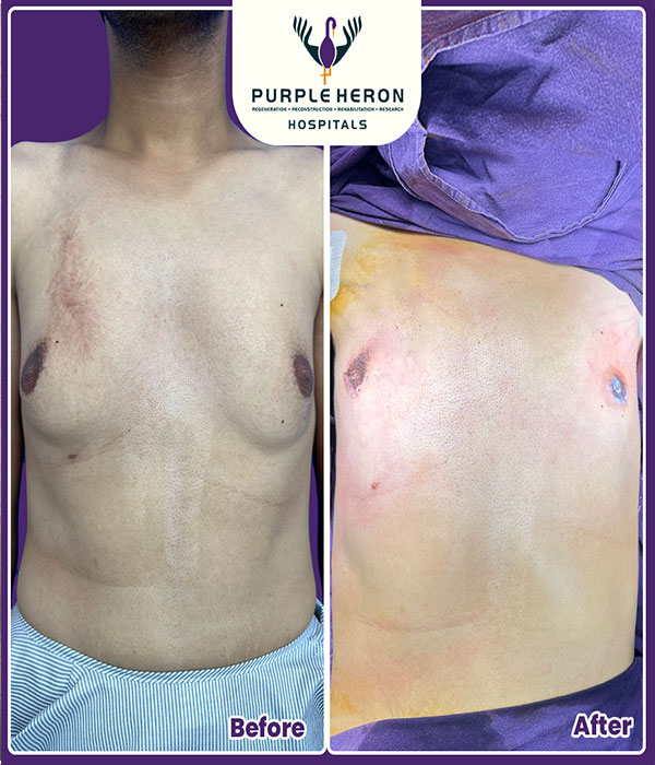 Gynecomastia Consultation
