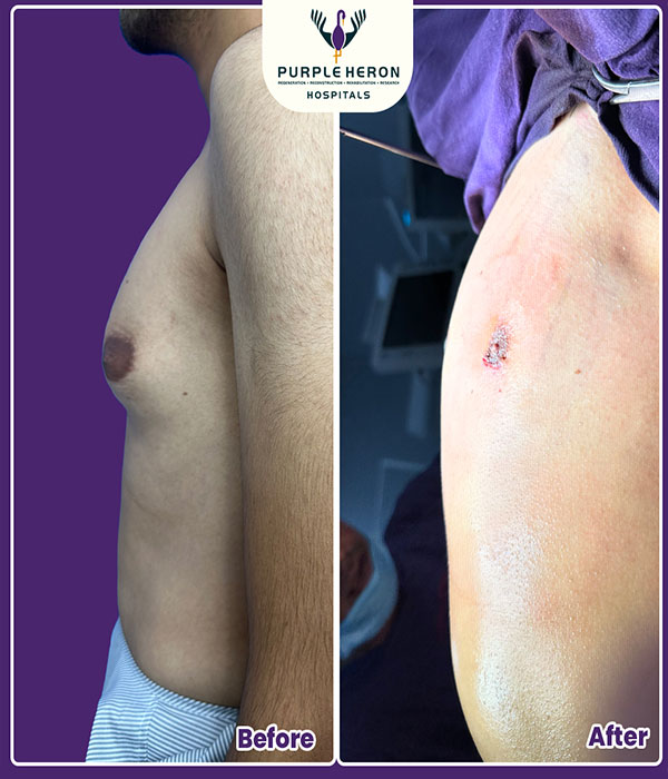 Gynecomastia Surgery Expertise