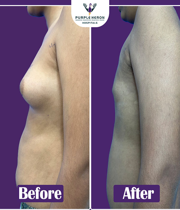 Gynecomastia Surgery Expertise
