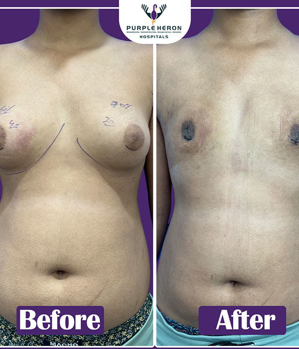 Gynecomastia Surgery Expertise