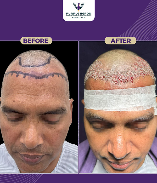Dr. Nitesh Lamoria Hair Transplant