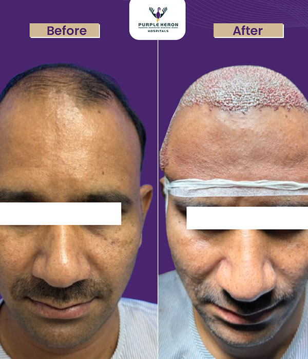 Hair Transplant Consultation