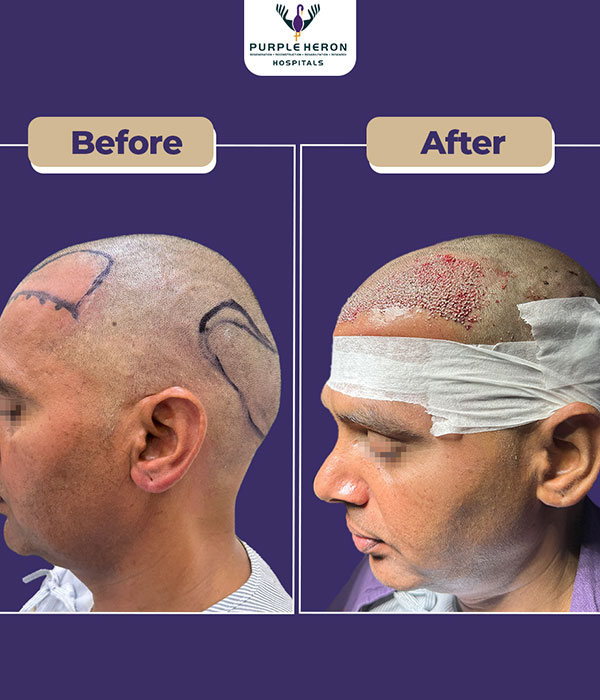 Hair Transplant Surgery Expertise