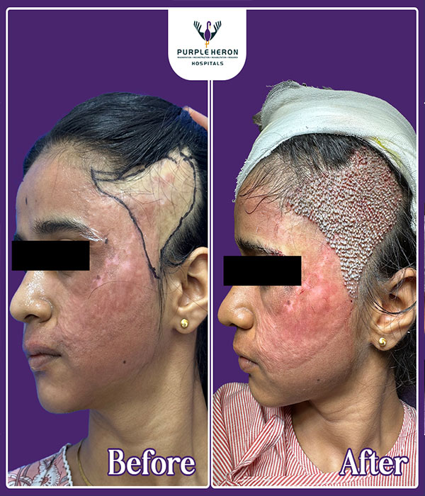 Hair Transplant Surgery Expertise