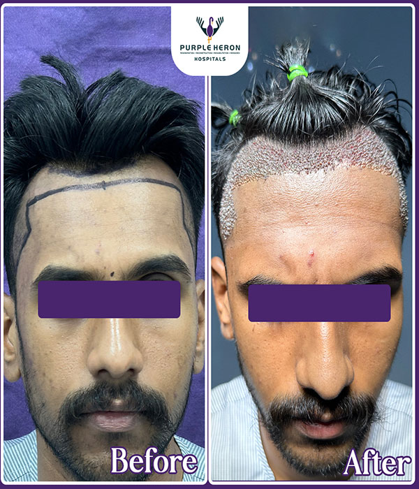 Hair Transplant Surgery Expertise