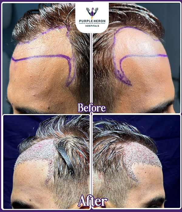 Hair Transplant Surgery Expertise