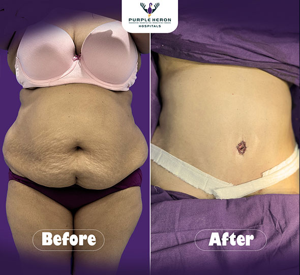 Plastic Surgery Patient of Dr. Nitesh Lamoria