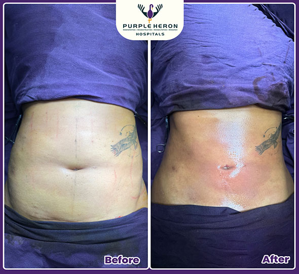 Plastic Surgery Patient of Dr. Nitesh Lamoria