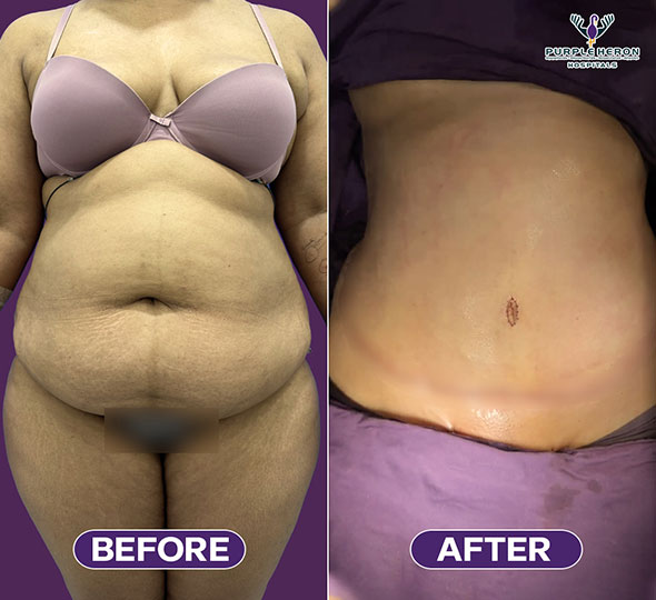 Plastic Surgery Patient of Dr. Nitesh Lamoria