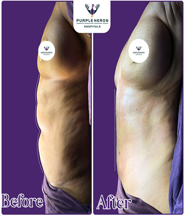 Hair Transplant Consultation