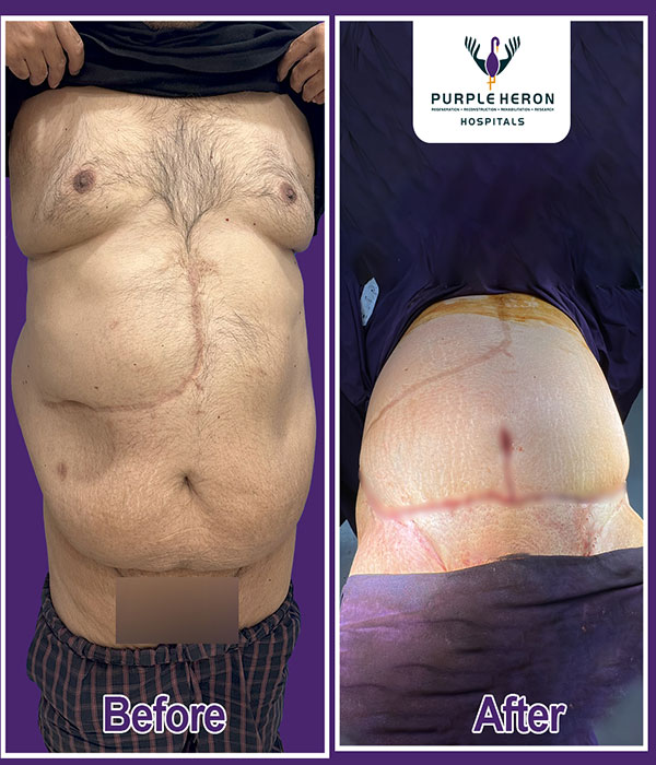 Hair Transplant Surgery Expertise