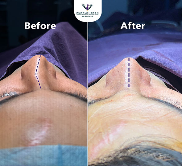 Plastic Surgery Patient of Dr. Lamoria