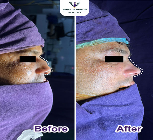 Plastic Surgery Patient of Dr. Lamoria