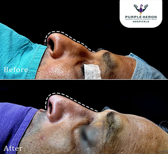 Plastic Surgery Patient of Dr. Lamoria