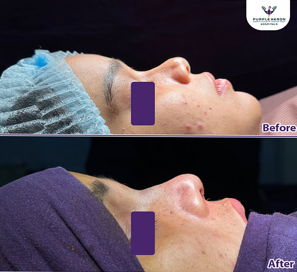 Plastic Surgery Patient of Dr. Lamoria