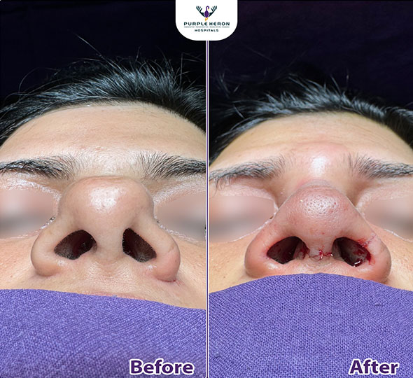 Plastic Surgery Patient of Dr. Lamoria