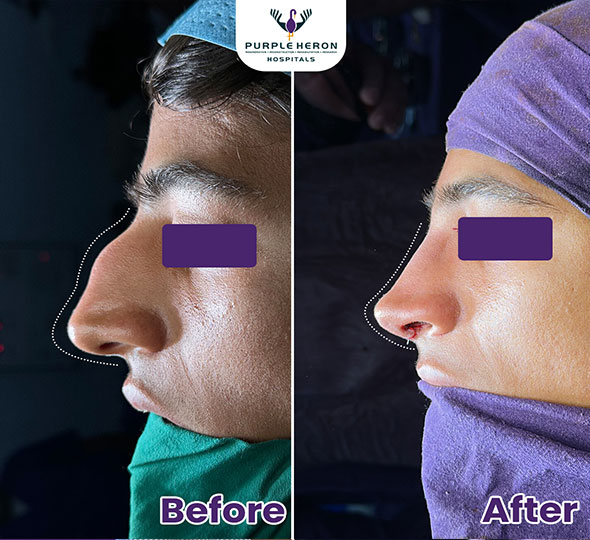 Plastic Surgery Patient of Dr. Lamoria