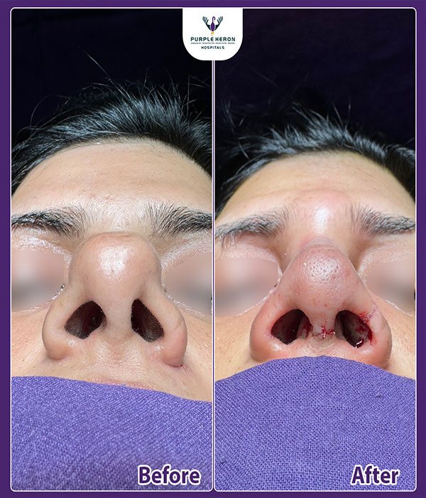 Rhinoplasty Consultation