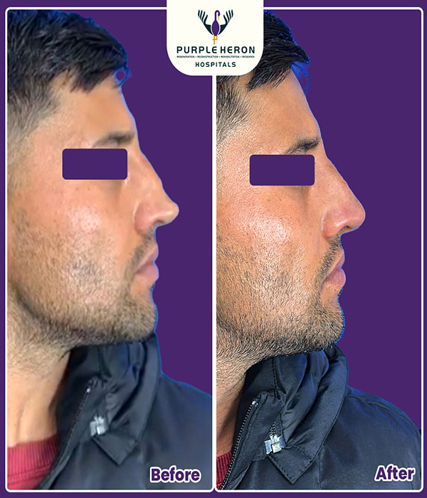Rhinoplasty Surgery Expertise
