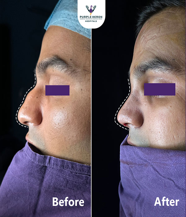 Rhinoplasty Surgery Expertise