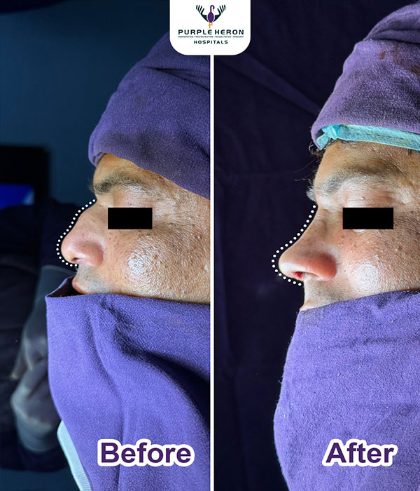 Rhinoplasty Surgery Expertise